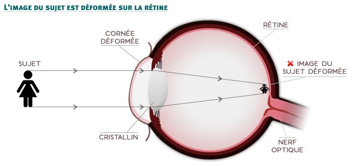 L'astigmatisme - d&eacute;formation de la courbure de la corn&eacute;e