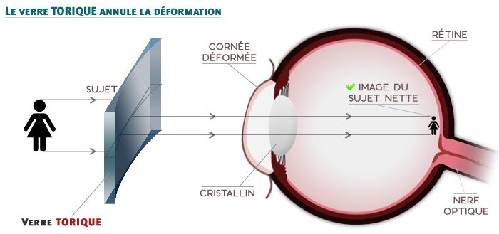 L'astigmatisme - Le verre torique annule la d&eacute;formation