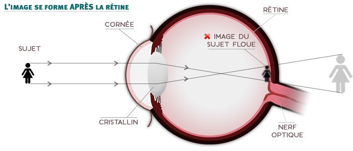 L'hyperm&eacute;tropie - l'image se forme apr&egrave;s la r&eacute;tine