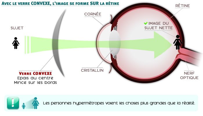 L'hyperm&eacute;tropie corrig&eacute;e