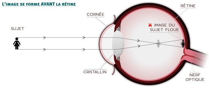 La myopie - sch&eacute;ma - l'image se forme avant la r&eacute;tine