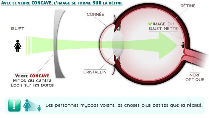 La myopie corrig&eacute;e